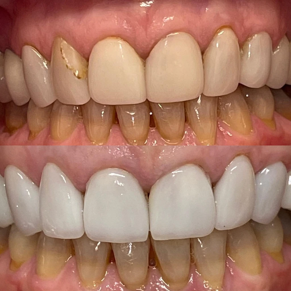 Deborah smiling before and after veneers