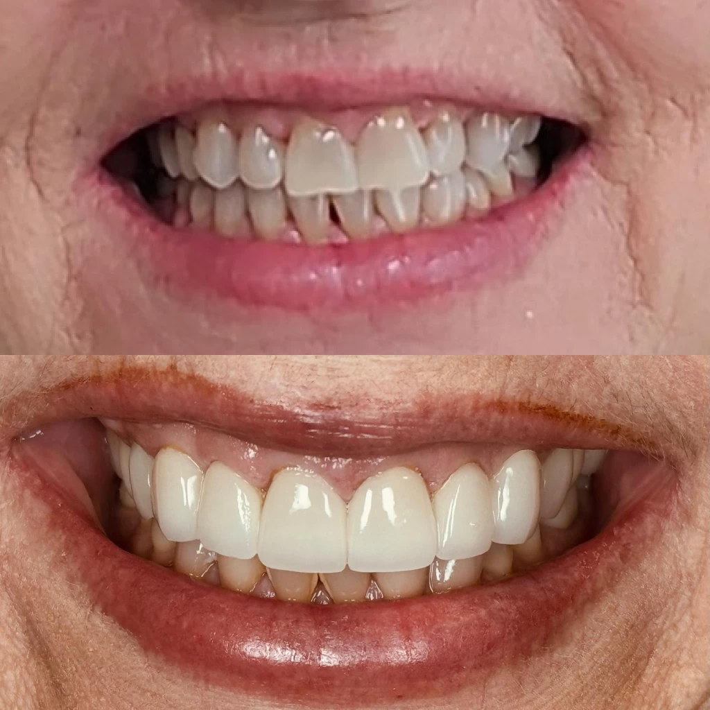 Diane smiling before and after veneers
