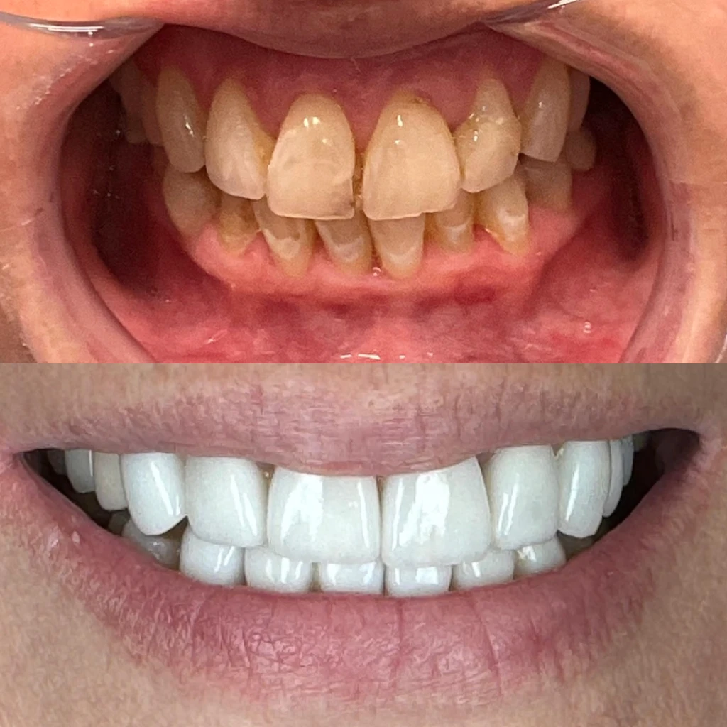 Mary smiling before and after veneers